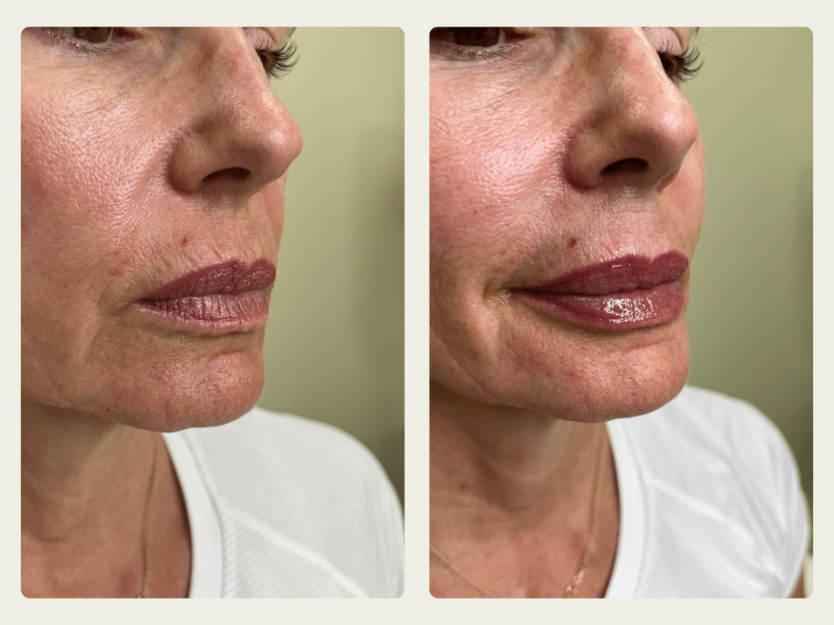 Lip Fillers 1 (1)