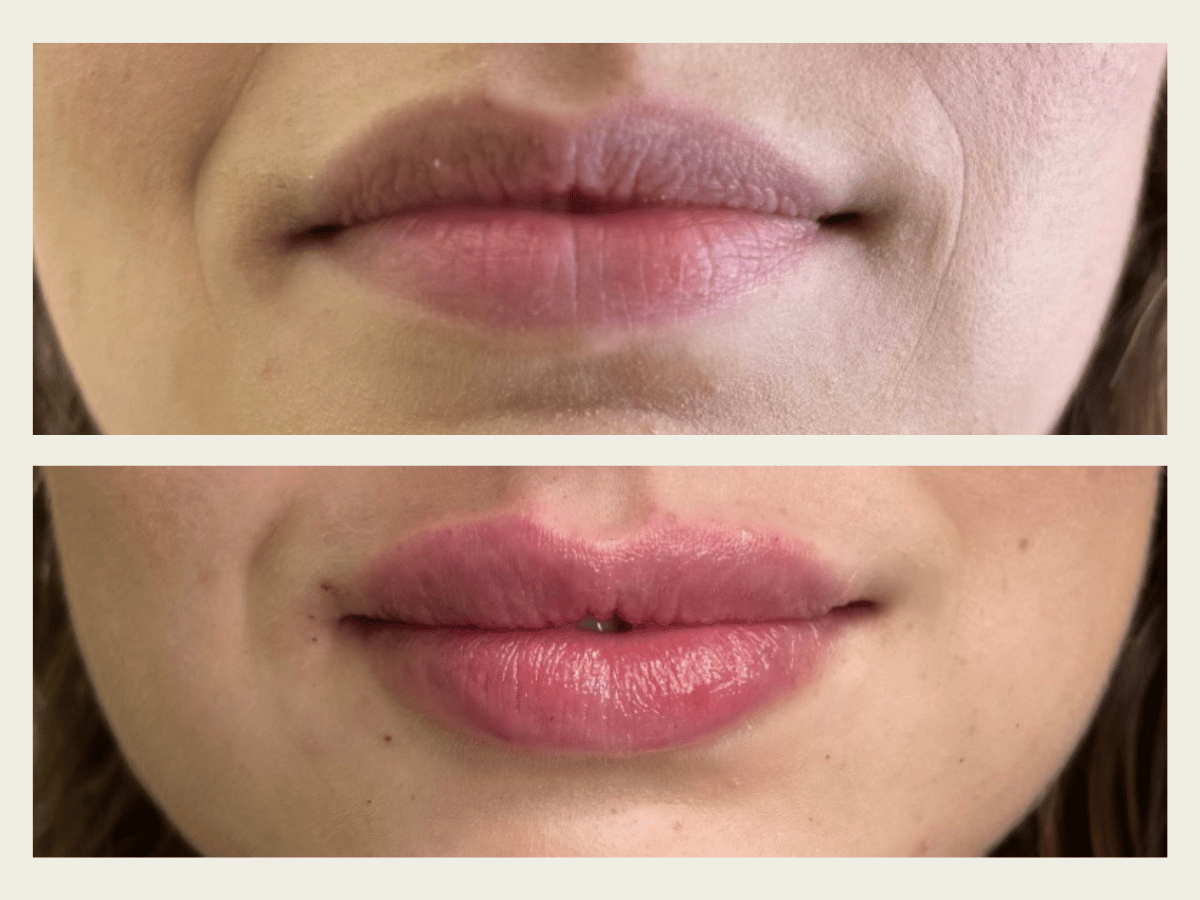 Lip Fillers 8